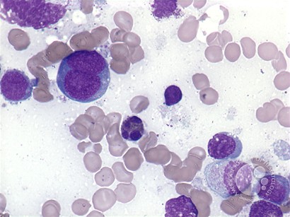 Extranodal NK/T-cell lymphoma - 3.
