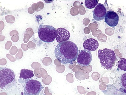 Extranodal NK/T-cell lymphoma - 4.