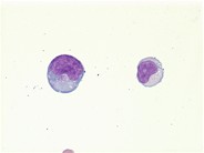 Extranodal NK/T-cell lymphoma - 5.