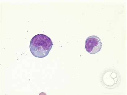 Extranodal NK/T-cell lymphoma - 5.