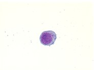Extranodal NK/T-cell lymphoma - 6.
