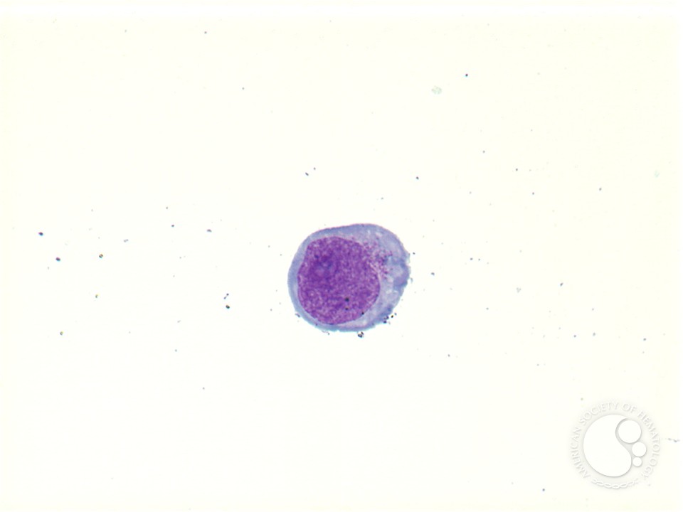 Extranodal Nk T Cell Lymphoma 6