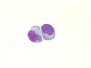 Extranodal NK/T-cell lymphoma - 7.