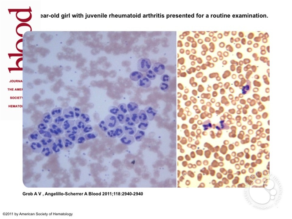 Leukoagglutination reported as platelet clumps