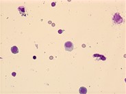 Myeloma: CNS - 1.