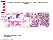 Plasma cell leukemia mimicking chronic lymphocytic leukemia