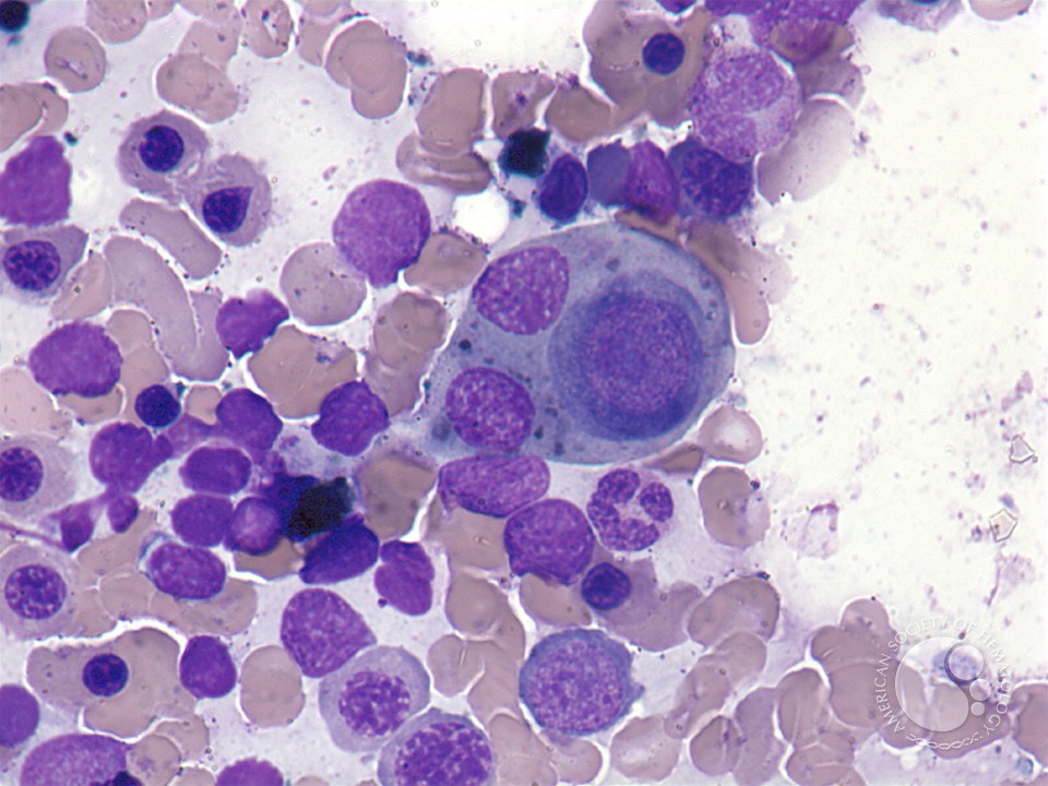 Phagocytic histiocyte - 1.