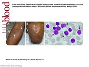 Cutaneous adult T-cell lymphoma leukemia