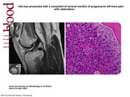 Knee pain: ACL, MCL, or CML?