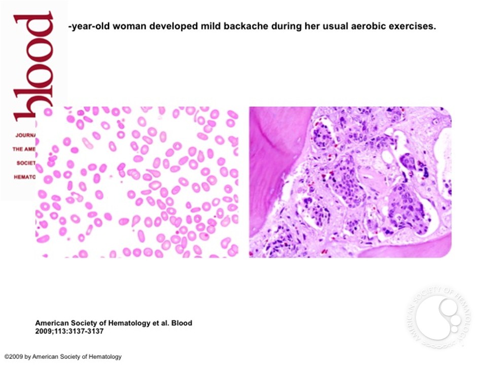 Backache and breast cancer
