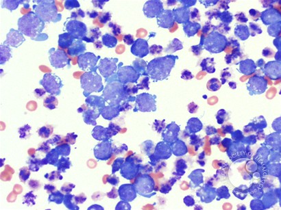 Burkitt lymphoma in ascitic fluid - 2.