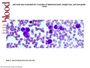 Anaplastic large cell lymphoma in bone marrow