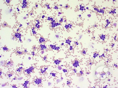 Acute megakaryocytic leukemia - 1.