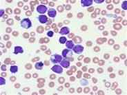 Acute megakaryocytic leukemia - 2.