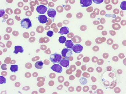 Acute megakaryocytic leukemia - 2.