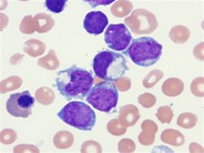 Acute megakaryocytic leukemia - 3.
