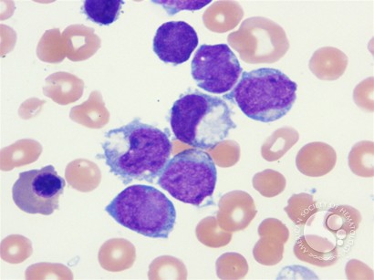Acute megakaryocytic leukemia - 3.