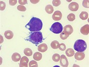 Acute megakaryocytic leukemia - 4.