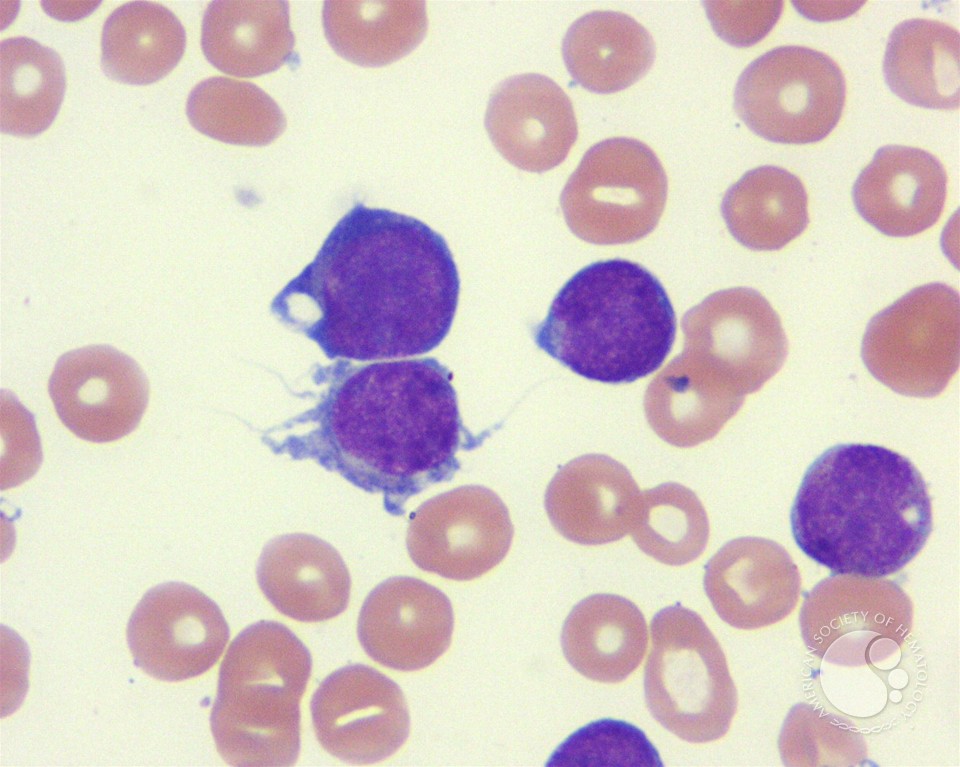 Acute megakaryocytic leukemia - 4.