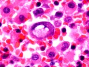 ALCL with completed erythrophagocytosis