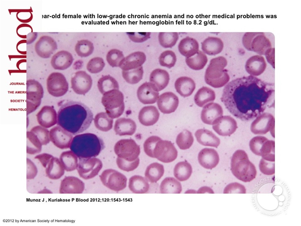 Lymphocytosis: T-cell large granular lymphocyte leukemia