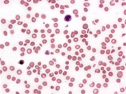 thrombocytopenic purpura
