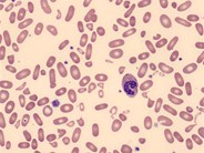 Pyropoikilocytosis