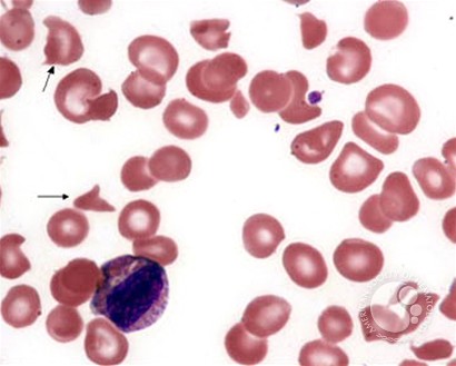 Thrombotic Thrombocytopenic Purpura - 2.