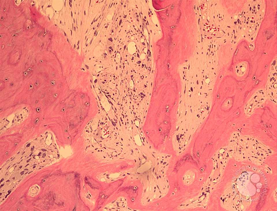 Primary myelofibrosis - fibrotic stage