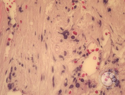 Primary myelofibrosis - fibrotic stage