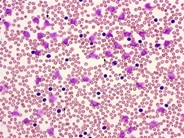 Chronic Lymphocytic Leukemia: Thrombocytopenia - 1.
