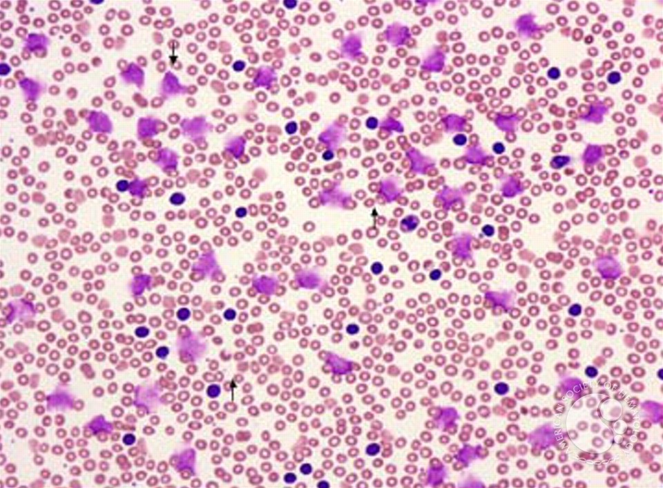 Chronic Lymphocytic Leukemia: Thrombocytopenia - 1.
