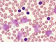 Chronic Lymphocytic Leukemia: Thrombocytopenia - 2.