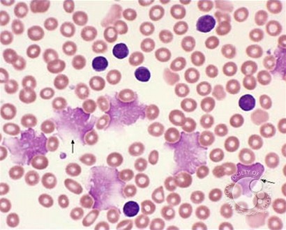 Chronic Lymphocytic Leukemia: Thrombocytopenia - 2.