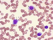 Chronic Lymphocytic Leukemia: Thrombocytopenia - 3.