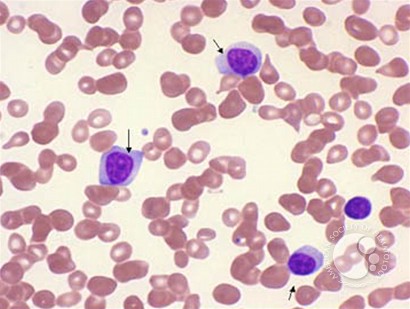 Chronic Lymphocytic Leukemia: Thrombocytopenia - 3.