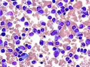 Chronic Lymphocytic Leukemia: Thrombocytopenia - 8.