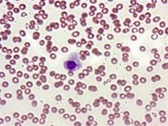 what is idiopathic thrombocytopenic purpura