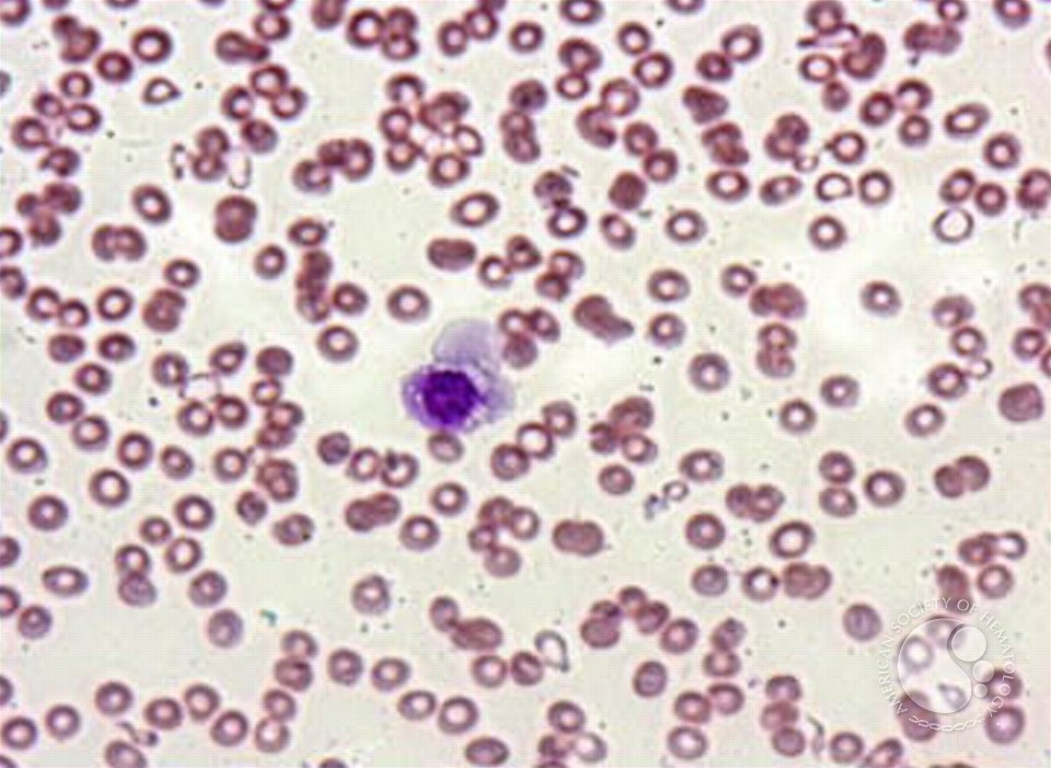 Idiopathic Thrombocytopenic Purpura - 3.