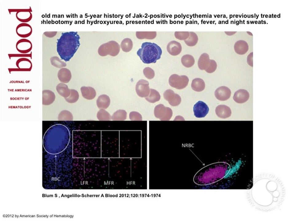 Block of red blood cell maturation in acute erythroid leukemia