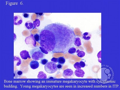 Idiopathic Thrombocytopenic Purpura - 6.