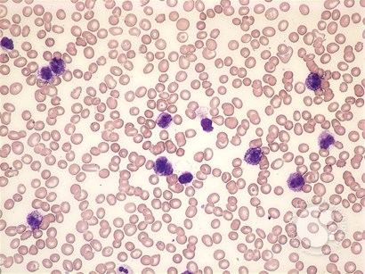 Mast cell leukemia