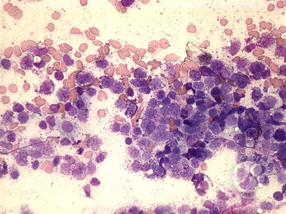 Mast cell leukemia