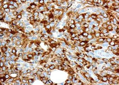 Acute Megakaryoblastic Leukemia - 4.
