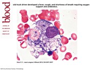 Histoplasmosis-induced pancytopenia