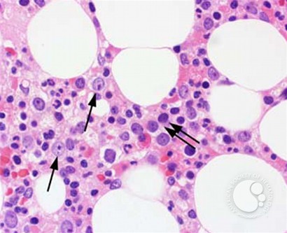 Myeloid Neoplasms. Myelodysplastic Syndrome: Refractory Ctyopenia with Multilineage Dysplasia - 3.