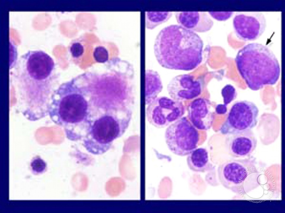 Myeloid Neoplasms. Myelodysplastic Syndrome: Refractory Ctyopenia with Multilineage Dysplasia - 7.