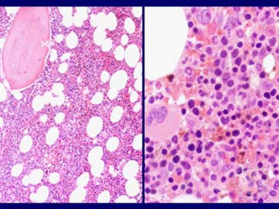 Myelodysplastic Syndrome: Refractory Anemia with Ringed Sideroblasts (RARS) - 2.