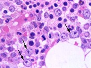 Myelodysplastic Syndrome: Refractory Anemia with Ringed Sideroblasts (RARS) - 3.