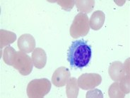 Hairy Cell Leukimia 102